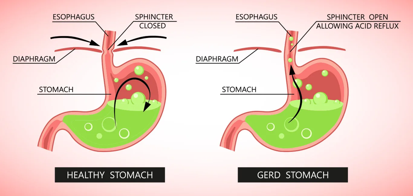 Gerd Rash Mengenal Gejala GERD (Gastroesophageal Reflux Disease)